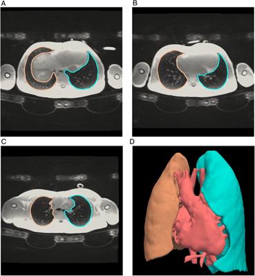 Possible effects of left pulmonary artery stenting in single ventricle patients on bronchial area, lung volume and lung function